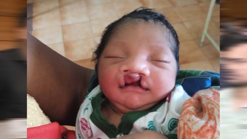 चिरायु टीम ने दिया एक परिवार को नया जीवन, जन्मजात विकृति से जूझ रहे बच्चे को मिल