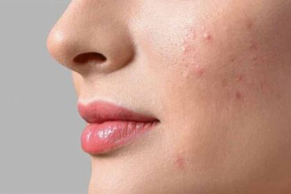 चेहरे पर बार-बार मुंहासे? समझ लें शरीर दे रहा है इन गंभीर समस्याओं का अलर्ट