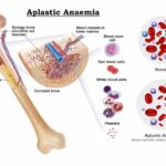 जब बोन मैरो करना बंद कर दे खून बनाना: एप्लास्टिक एनीमिया क्यों है साधारण एनीमिया