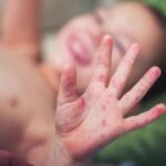 मध्यप्रदेश में बढ़ा खसरे का खतरा: 4 जिलों में 12 केस मिले, स्वास्थ्य विभाग ने जा