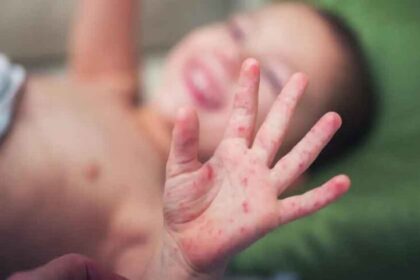 मध्यप्रदेश में बढ़ा खसरे का खतरा: 4 जिलों में 12 केस मिले, स्वास्थ्य विभाग ने जा